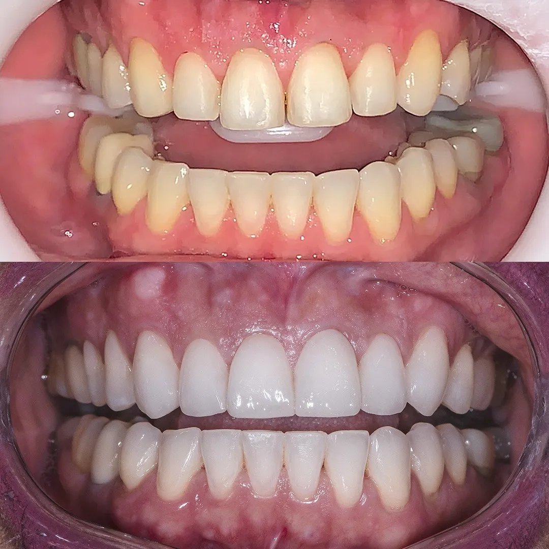 Resultado de tratamento odontológico 1