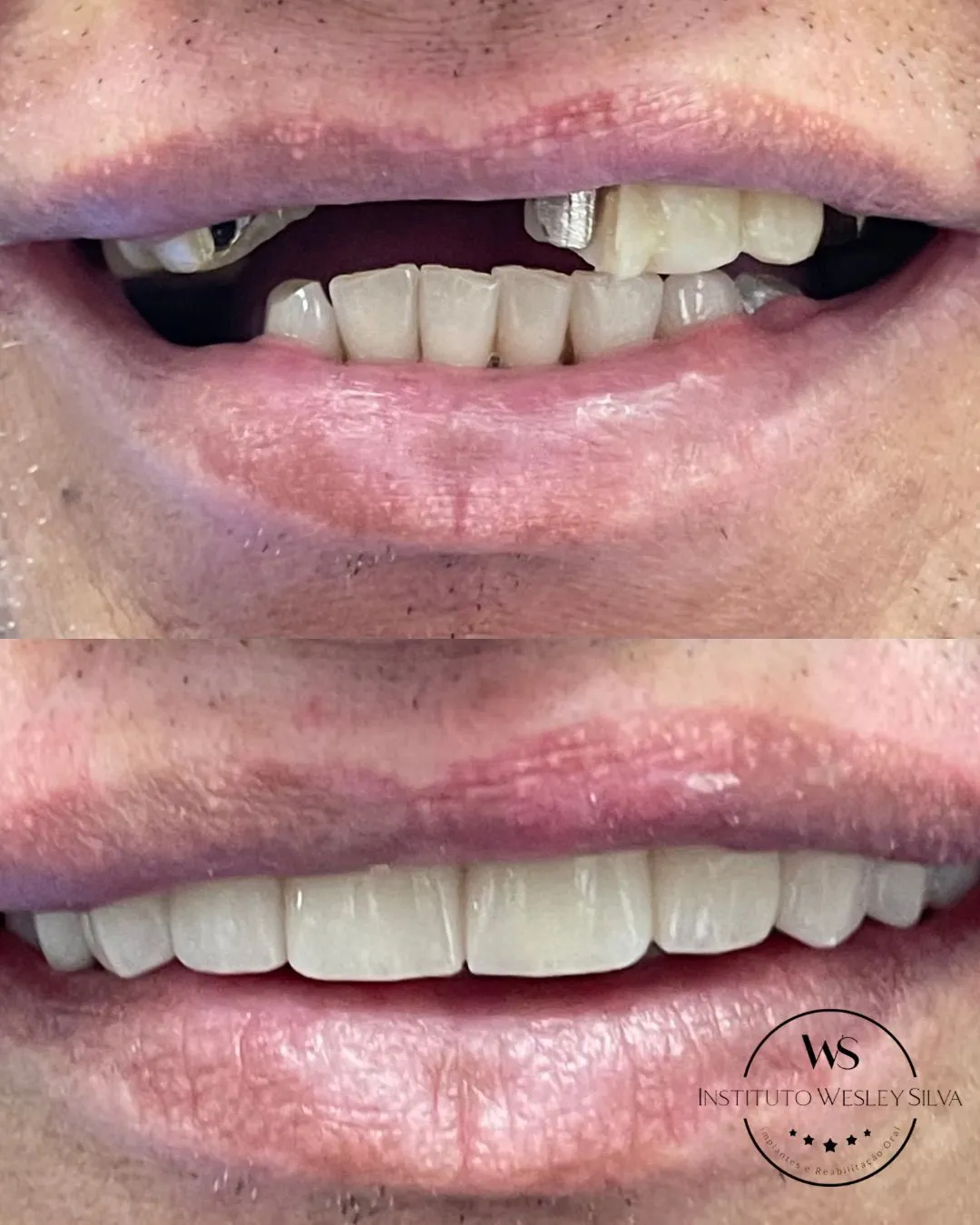 Resultado de tratamento odontológico - Caso recente 1