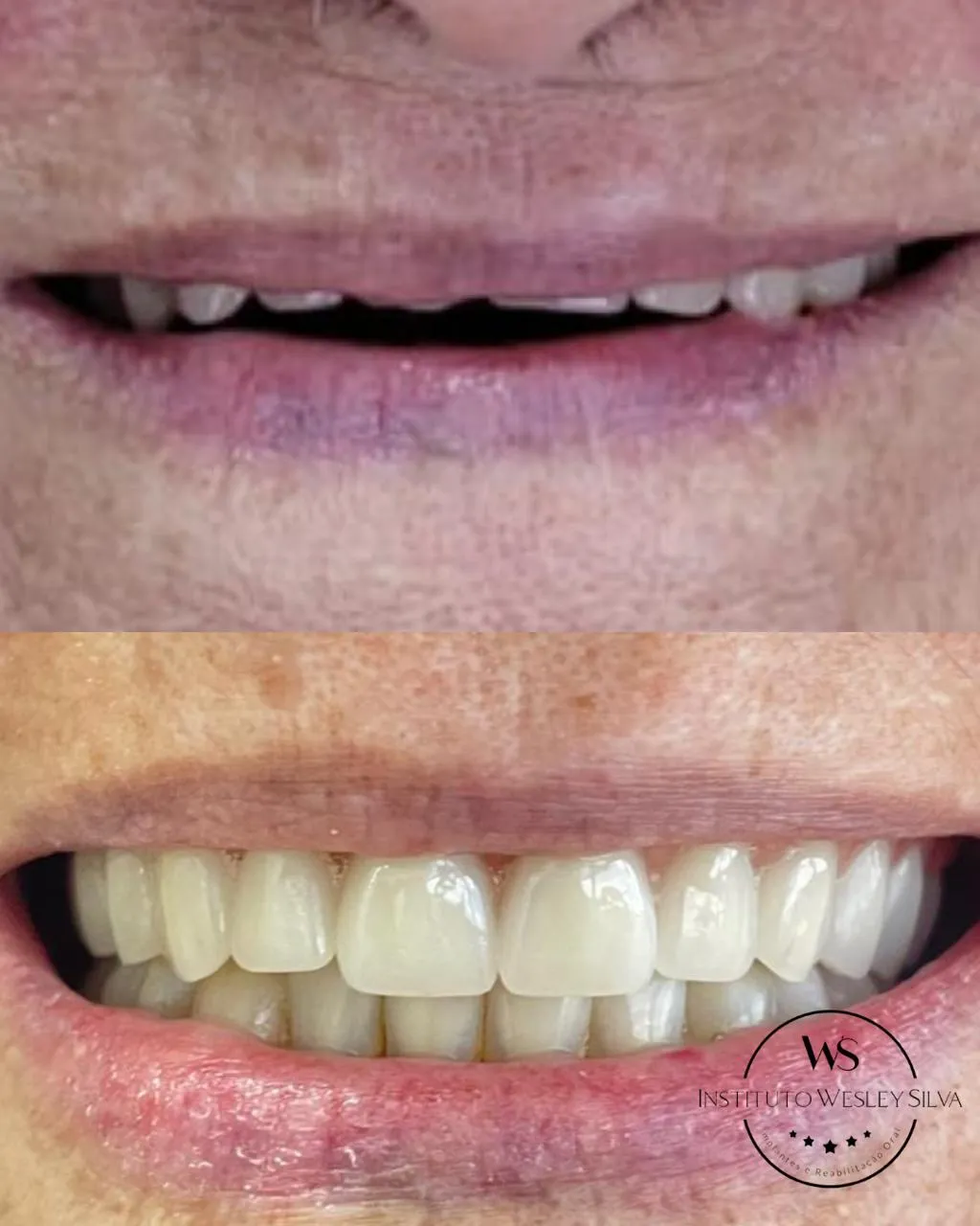 Resultado de tratamento odontológico - Caso recente 3