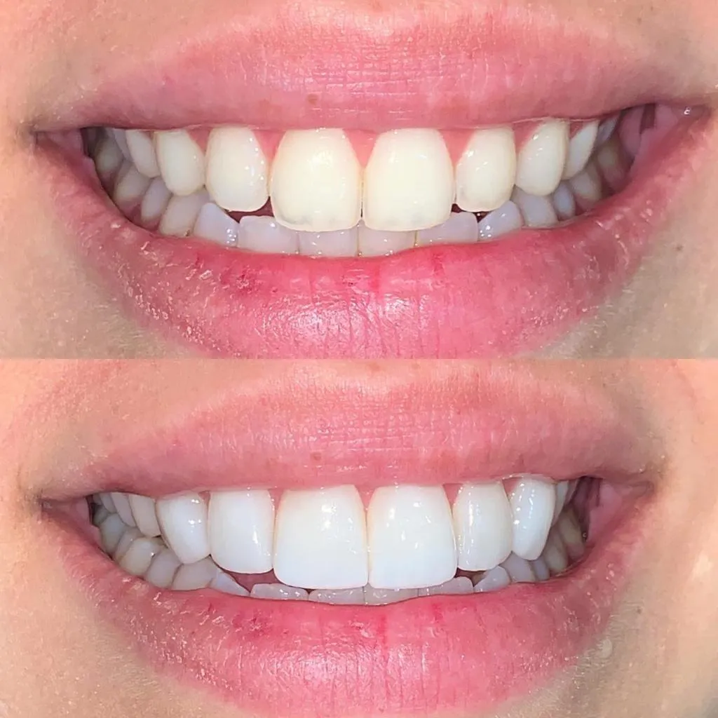 Resultado de tratamento odontológico 5