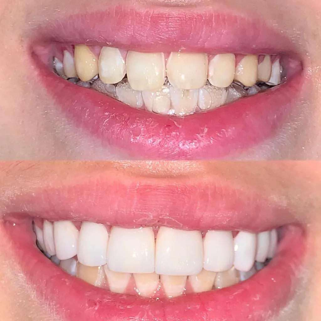 Resultado de tratamento odontológico 8